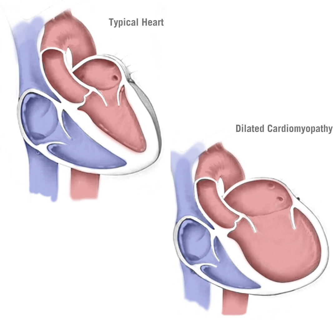 Dilated Cardiomyopathy Sketch